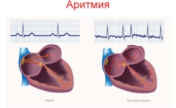 Аритмия при алкоголизме